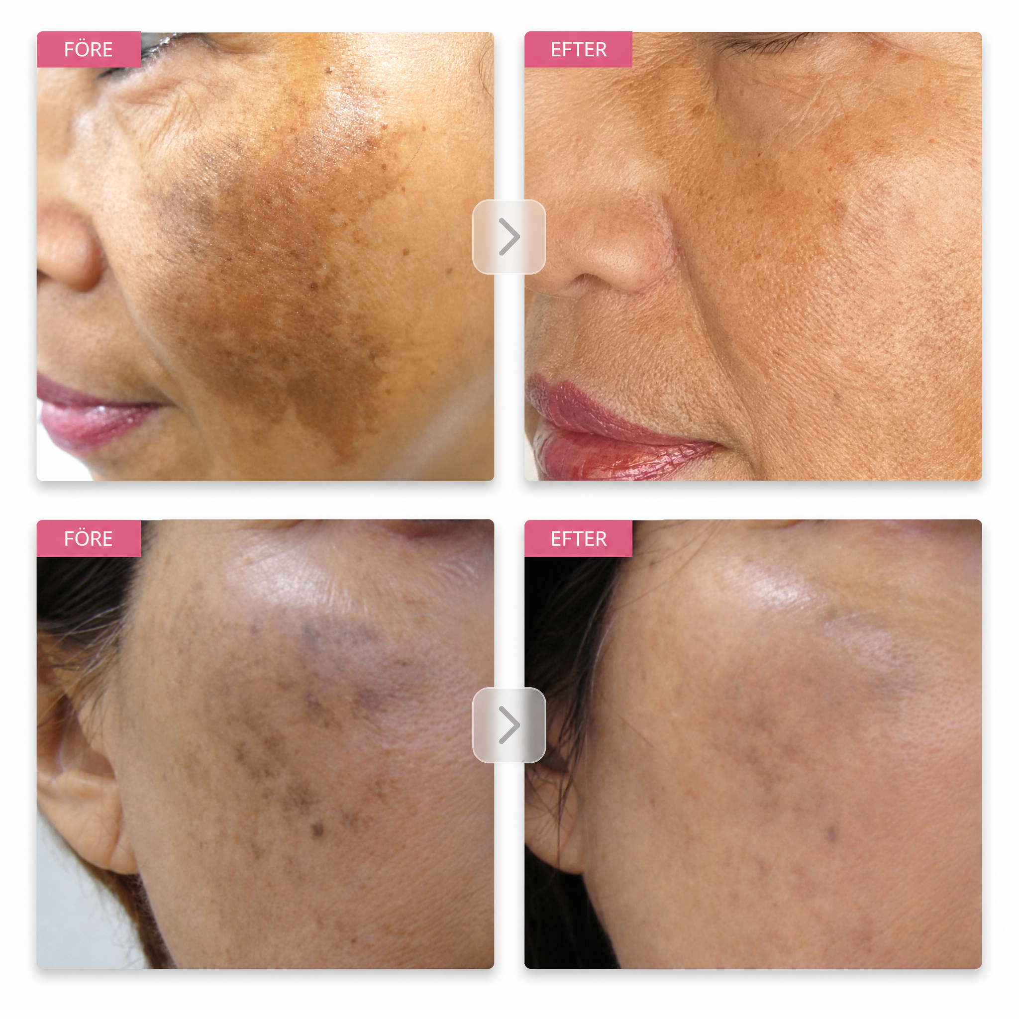 Velvionna – Arbutin 7% + Tranexamic Acid Brightening Cream