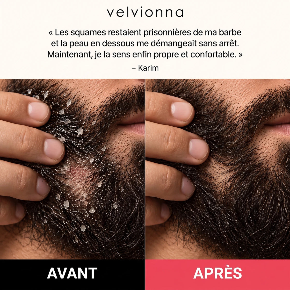 Avant / après sur la barbe