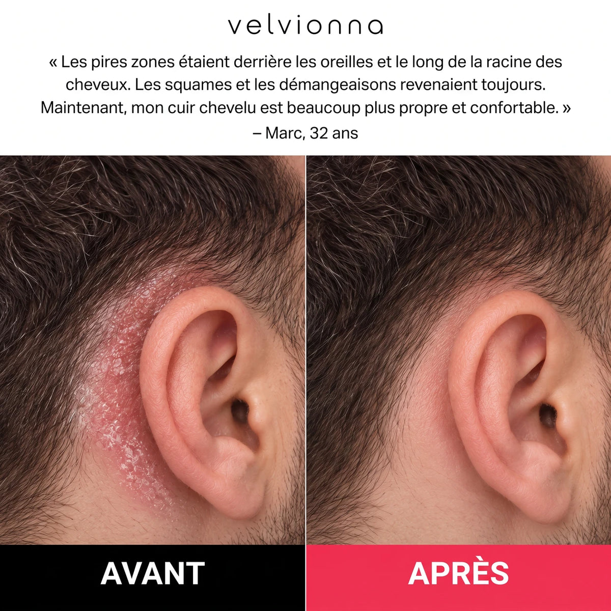 Avant / après derrière l'oreille